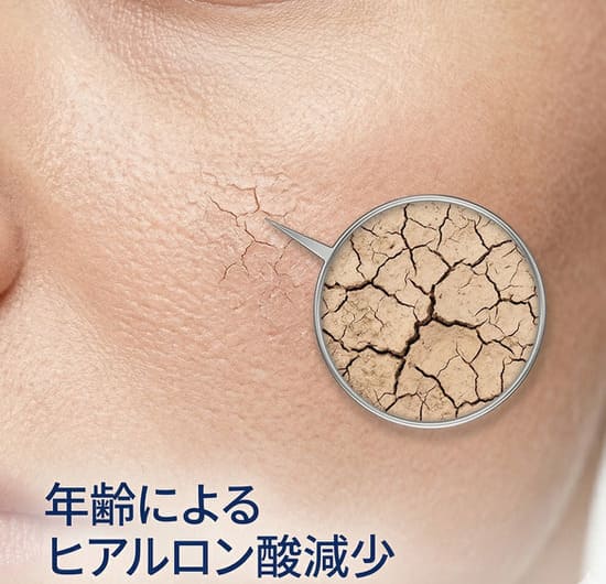 乾燥・くすみ・カサカサ・目元口元（ヒアルロン酸不足の肌のイメージ）